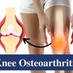 knee osteoarthritis physiotherapy
