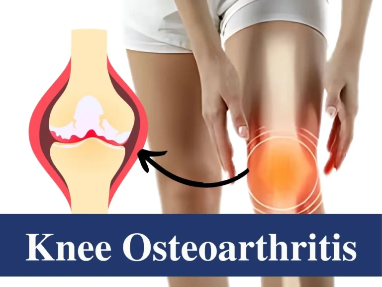knee osteoarthritis physiotherapy